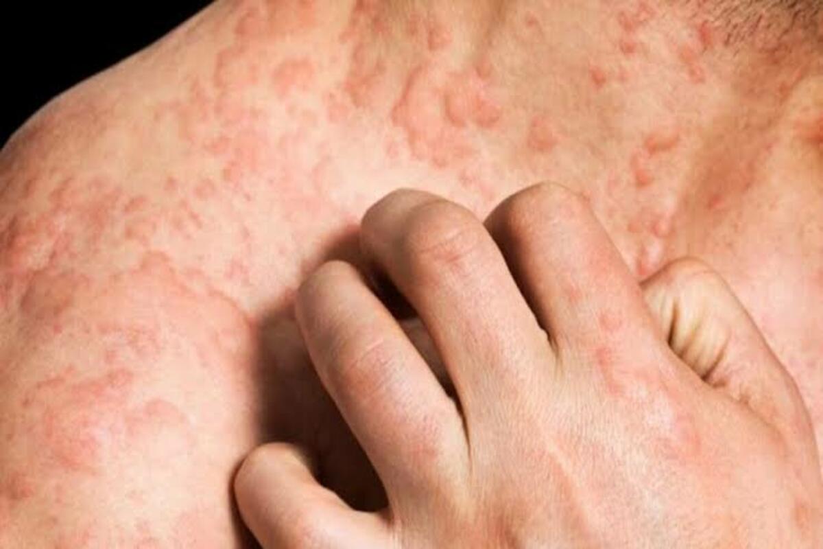 eczema disease