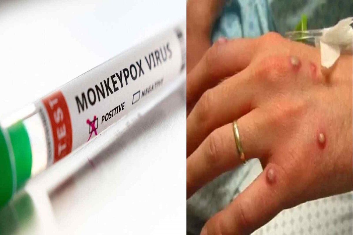 increased risk of monkeypox