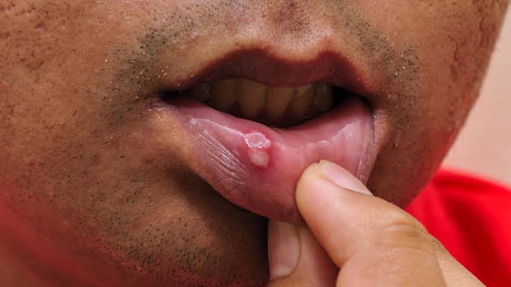 health tips mouth ulcer