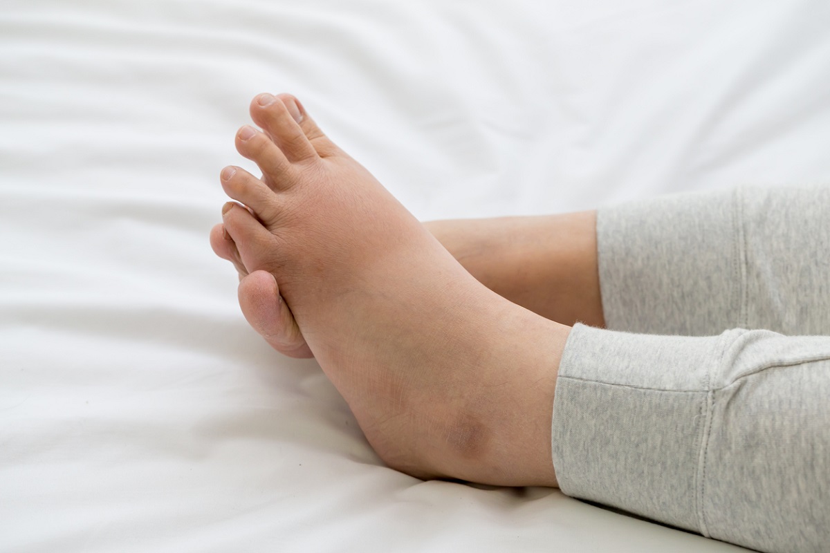 foot sweling can symptoms of liver damage