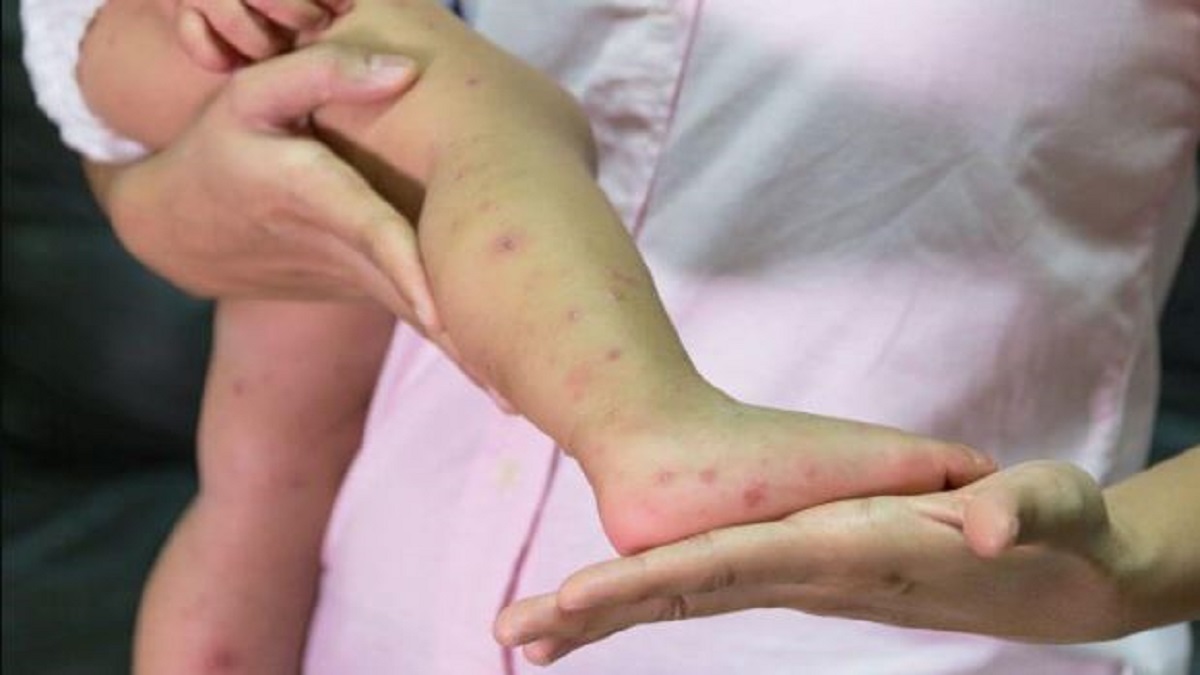 5 measles patients Pune
